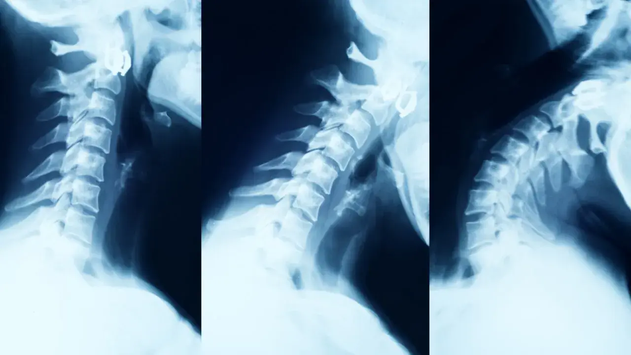Kawa przed RTG kręgosłupa: Uniknij błędnej diagnozy!