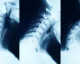 Kawa przed RTG kręgosłupa: Uniknij błędnej diagnozy!