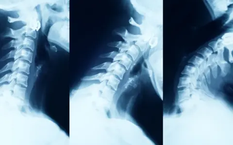 Kawa przed RTG kręgosłupa: Uniknij błędnej diagnozy!