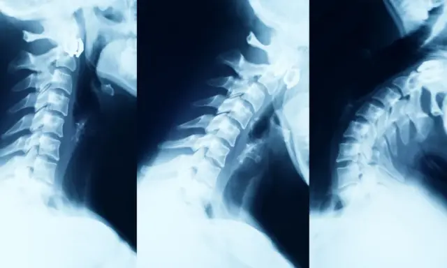 Kawa przed RTG kręgosłupa: Uniknij błędnej diagnozy!